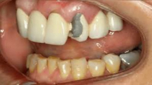 강서구 마곡동 치과 잇몸 경계의 검은 선, 지르코니아 크라운 으로 지울 수 있을까? 관련 이미지 1