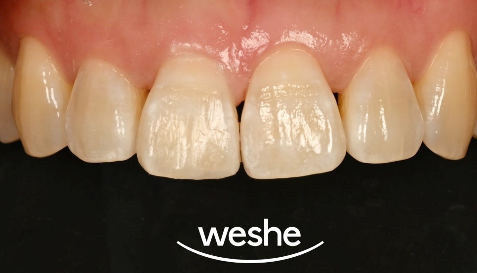 마곡 치과 에서 알려드리는 앞니 끝 깨짐, 치아 파절 레진 치료 방법 관련 이미지 6