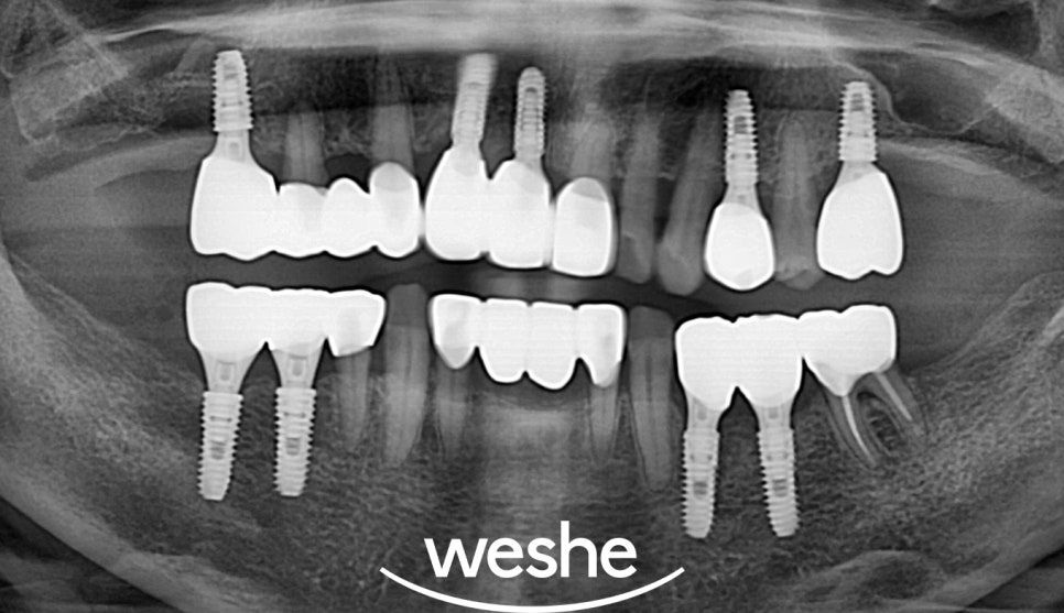 벌어진 치아 사이 (치간이개) 와 치주질환 이 동시에 있을 때, 송정역 치과 임플란트 치료 설명글 관련 이미지 10