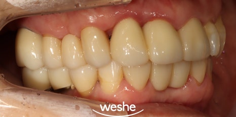 벌어진 치아 사이 (치간이개) 와 치주질환 이 동시에 있을 때, 송정역 치과 임플란트 치료 설명글 관련 이미지 13