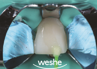 앞니 끝 깨짐 발산 치과 치아 라미네이트 치료 과정 관련 이미지 10