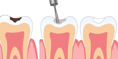 얼룩덜룩한 치아, 단순 착색, 변색일까요? 강서구 치과 법랑질 저형성증 치료법 소개글 관련 이미지 8