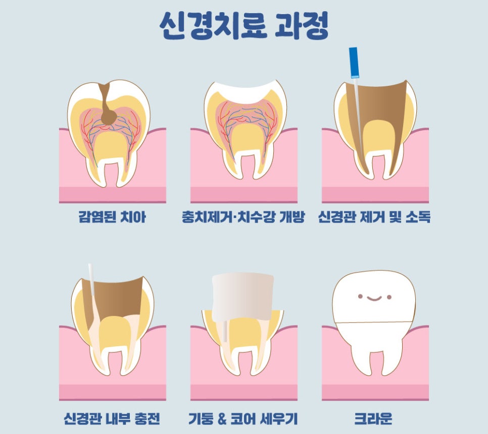 연세위시치과 여상호 대표원장이 알려주는 신경치료의 중요성(feat. 치과보존과 전문의) 관련 이미지 8