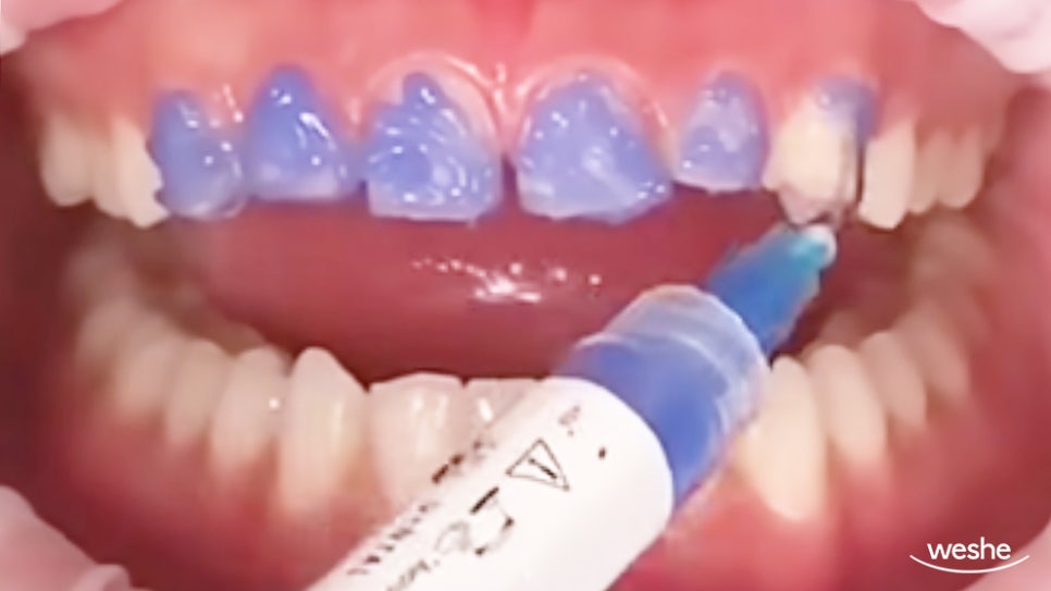 송정역 치과 앞니가 벌어졌을 때, 심미치료를 위한 라미네이트 제작 시 고려사항 관련 이미지 3