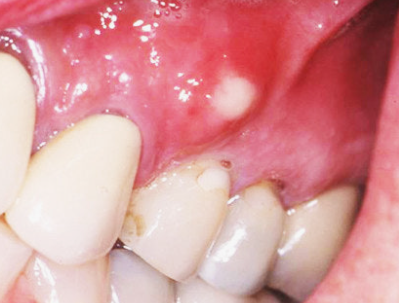 A Pus Pocket on the Gums: Will It Get Better with Antibiotics Alone? image 2