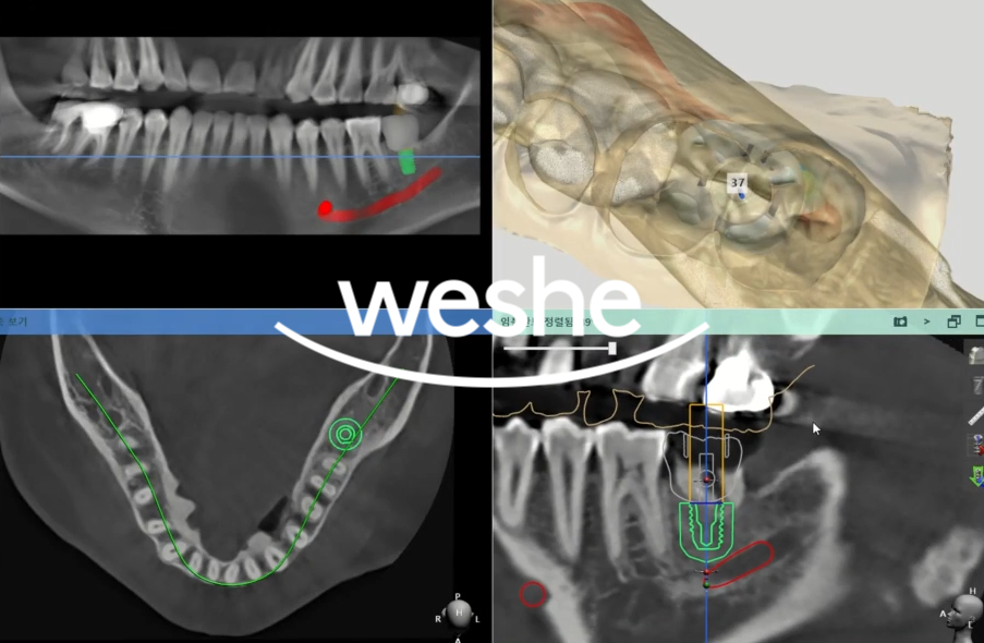 위턱 전체 임플란트 마곡동 치과 수면치료(의식하진정법)을 활용한 진료 방법 관련 이미지 7
