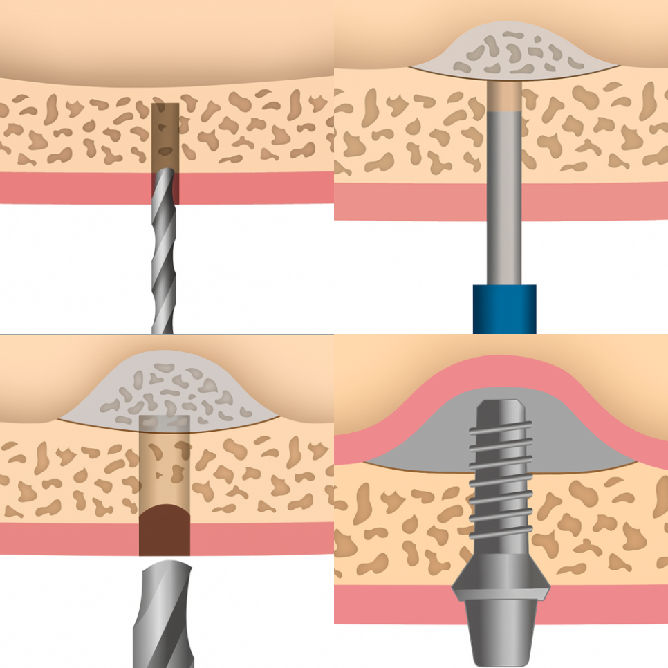 강서구 치과 어금니 임플란트 가용골 부족할 때 네비게이션 1차 2차 수술 로 해결하는 방법 관련 이미지 8
