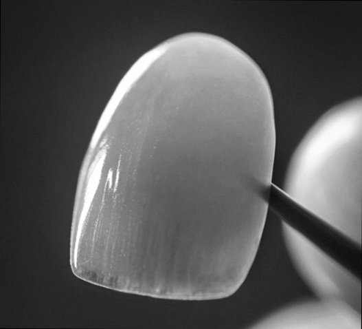 앞니 레진 변색, 티 안 나는 라미네이트 교체와 비율 개선할 수 있을까? 마곡역 치과 관련 이미지 3