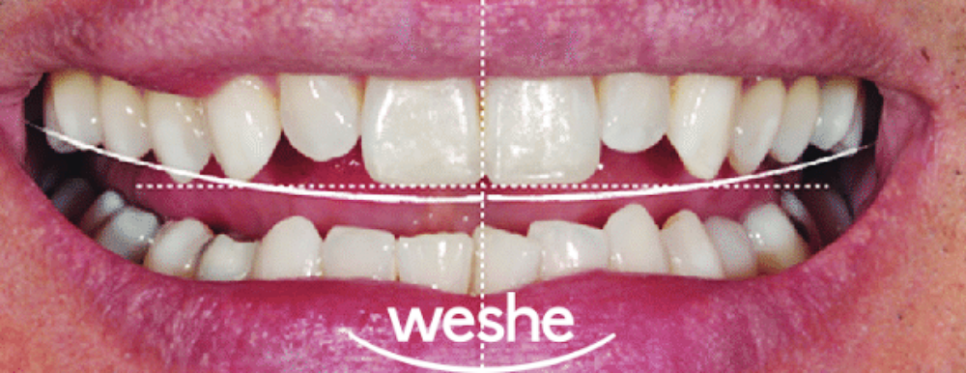 발산 치과 왜소치 치료, 레진과 치아 라미네이트 중 어떤 것이 좋을까? 진료 방법 차이와 보철 수복 과정 관련 이미지 2