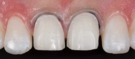 앞니 끝 깨짐 연세위시치과 라미네이트 제작 과정, 관리 관련 이미지 3