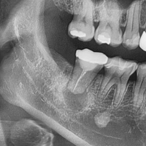 마곡역치과 치아, 진짜 뽑아야 되는 걸까요? 치아재식술이란? 관련 이미지 3