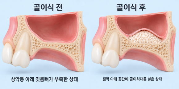 위 어금니 잇몸뼈가 부족하다면? 상악동 거상술이 필요한 이유 관련 이미지 1