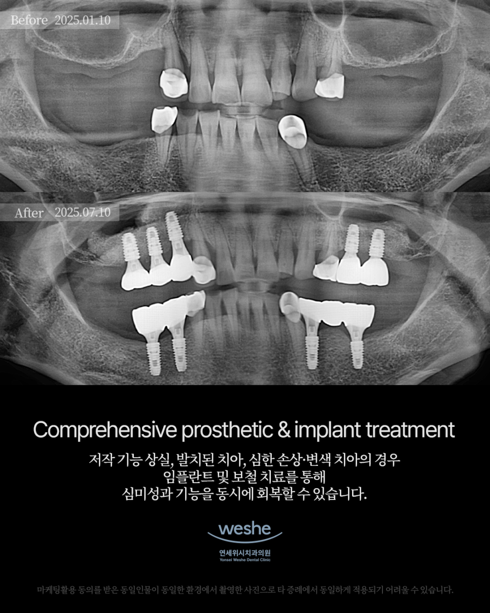 ✨ Comprehensive Prosthetic & Implant Treatment - Before and After Orthodontic Prosthetic Treatment and Implant Surgery ✨ image 1