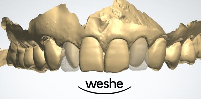 유독 작은 치아 어떻게 해결할 수 있나요? 마곡역 치과 앞니 왜소치 라미네이트 치료 과정 관련 이미지 5