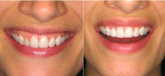 강서구 치과 앞니 라미네이트 제작을 위한 단계 진단 및 분석 절차 과정은? 관련 이미지 1