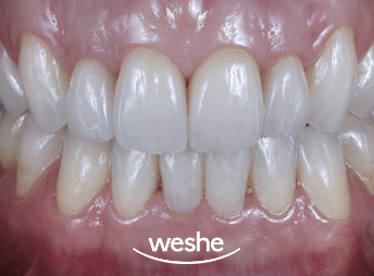 송정 치과 치아 배열이 틀어졌을 때, 앞니 라미네이트 치료 과정 관련 이미지 10