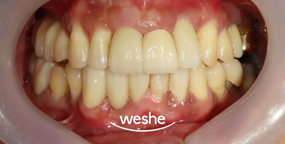 마곡동 치과 치주질환으로 인한 치아 벌어짐, 그리고 임플란트 치료 과정 관련 이미지 6