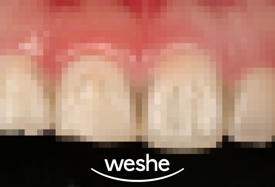 마곡 치과  앞니 깨짐, 크라운 없이 레진으로 치료가 가능할까? 진료 방법을 선택하는 기준과 과정 관련 이미지 1