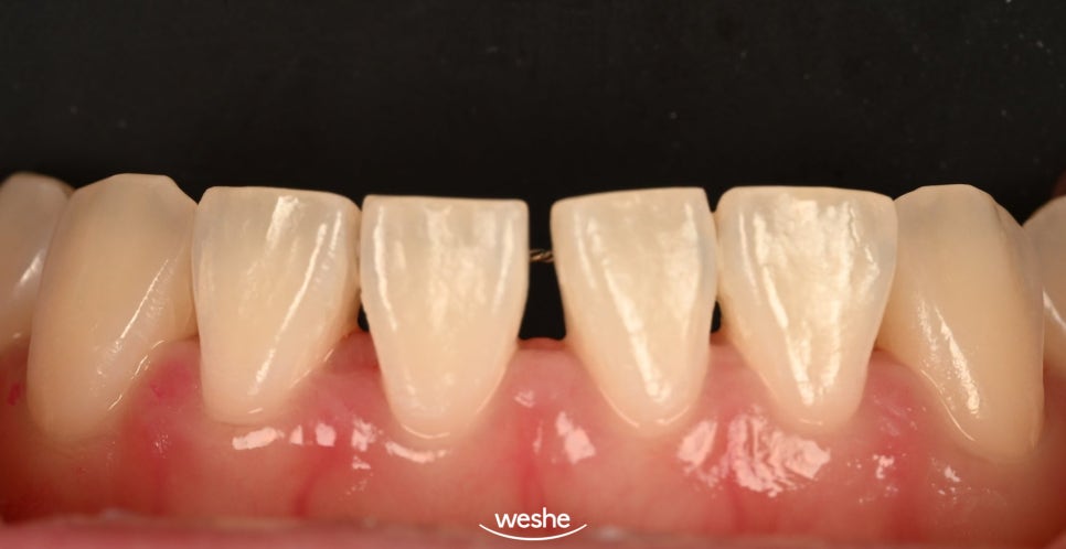 [마곡 치과] 교정 후 다시 벌어진 앞니, 재교정 없이 무삭제 라미네이트로 해결 하는 방법 을 알려드리겠습니다. (원내기공실) 관련 이미지 2