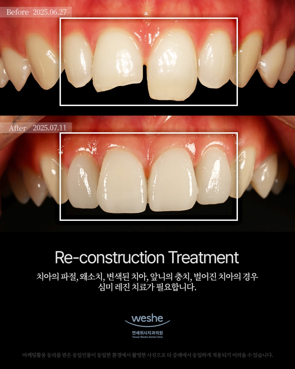 ✨ Esthetic Prosthetic Transformation &ndash; 라미네이트 치료 전후 ✨ 관련 이미지 1