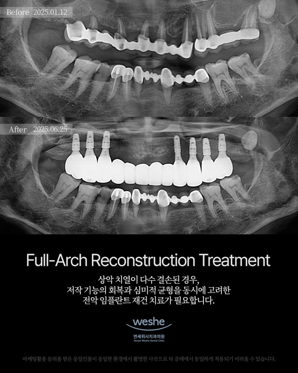 ✨ Full-Arch Reconstruction Treatment &ndash; 전악 임플란트 수술 전후 ✨ 관련 이미지 1