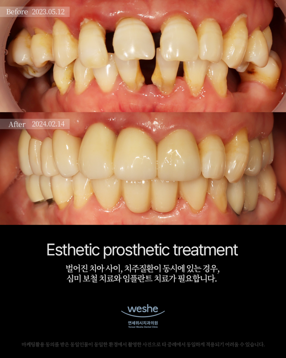 ✨ Esthetic prosthetic treatment - 심미 보철 치료와 임플란트 수술 전후 ✨ 관련 이미지 1