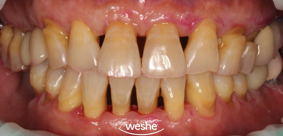 마곡역 치과 구강 관리의 기초는? 칫솔질, 스케일링, 잇몸치료의 중요성 관련 이미지 4