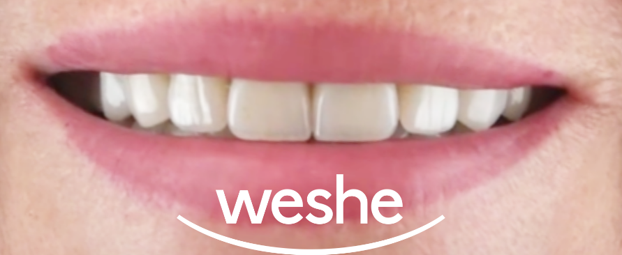 강서구 치과 웃을 때 앞니가 이상해 보인다면? 라미네이트 치료 로 자신감을 되찾으세요 관련 이미지 5