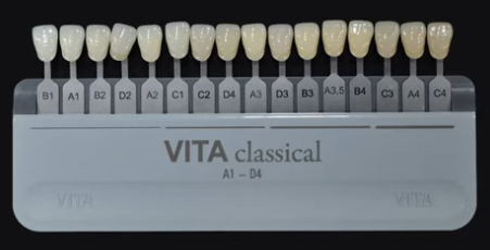 마곡 치과 넘어짐 으로 인한 앞니 치아 끝 살짝 깨짐, 증상에 따라 치료 방법이 달라집니다. 레진 수복 케이스 관련 이미지 3