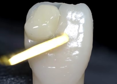 마곡동 치과 치아 파절 로 인한 레진 치료, 어떤 경우에 가능할까요? 관련 이미지 5