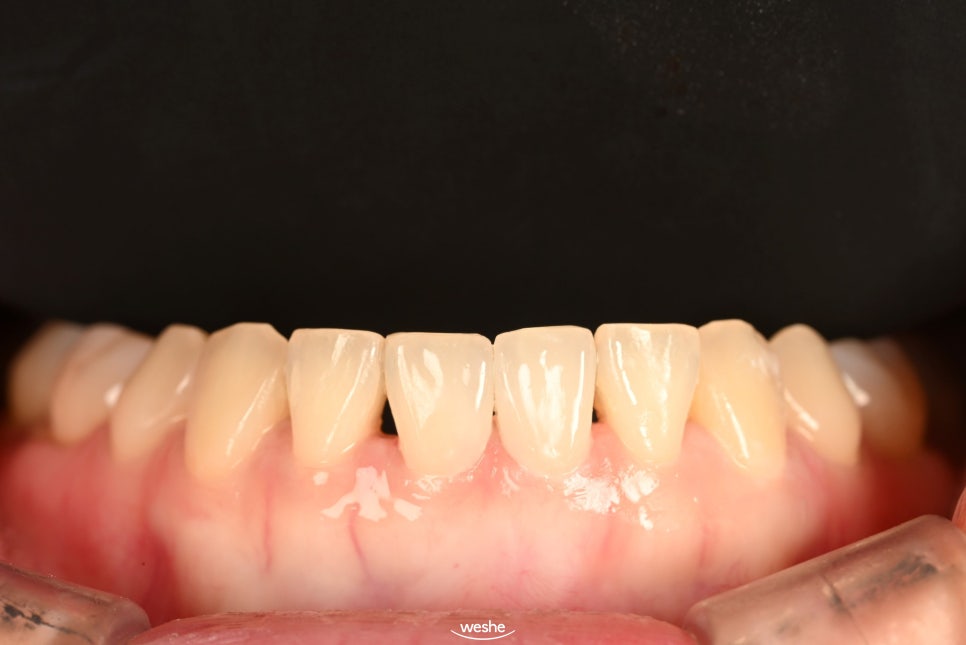 [마곡 치과] 교정 후 다시 벌어진 앞니, 재교정 없이 무삭제 라미네이트로 해결 하는 방법 을 알려드리겠습니다. (원내기공실) 관련 이미지 4