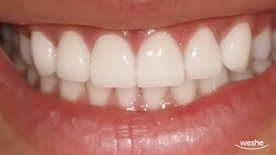 송정역 치과 앞니가 벌어졌을 때, 심미치료를 위한 라미네이트 제작 시 고려사항 관련 이미지 4