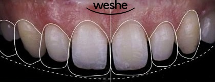 😁 웃을 때 치아 사이 가 벌어져 보인다면? 마곡동 치과 라미네이트 로 해결! 관련 이미지 6