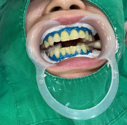 Magok Teeth Whitening: WISH Whitening Combining Professional and At-Home Whitening image 6