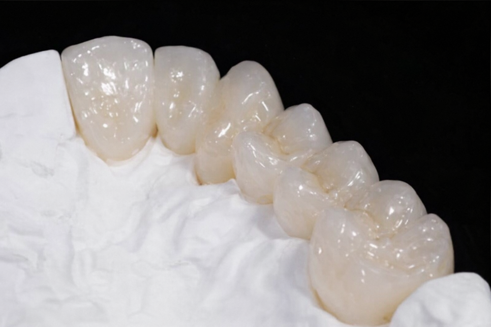 마곡역 치과 신경치료 후 크라운까지 마무리하는 진짜 이유와 지르코니아의 장점 관련 이미지 4