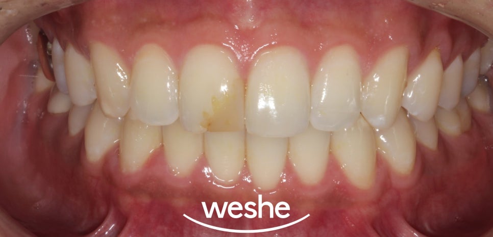 마곡역 치과 앞니 레진 변색 고민 끝, 크라운 치료로 환한 미소 되찾기 관련 이미지 1