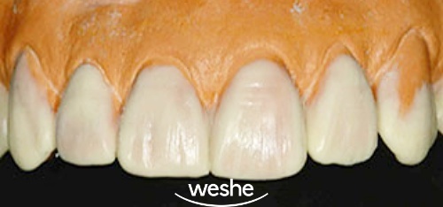 송정역 치과 치간이개(앞니 사이 벌어짐)의 원인과 해결법, 라미네이트 수복 과정 정리 관련 이미지 2