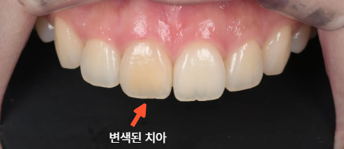 신경치료후 앞니 한 개만 색이 어두워졌다면 먼저 확인할 것-실활치미백 관련 이미지 1