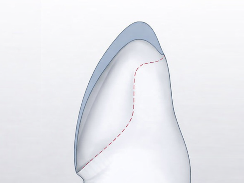 마곡 치과 에서 부작용 걱정 없는 라미네이트 선택 기준 알려드립니다. 관련 이미지 2