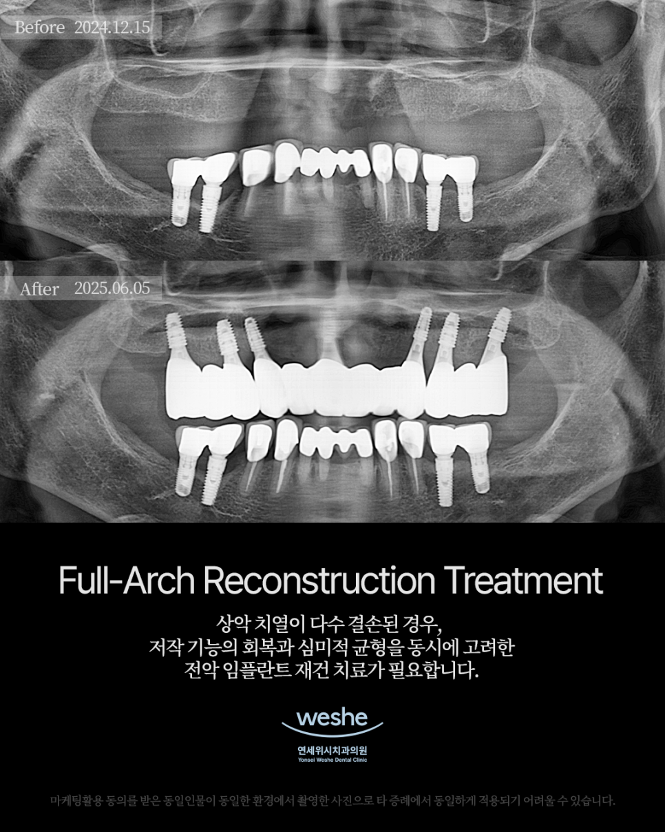 ✨ Full-Arch Reconstruction Treatment &ndash; 전악 임플란트 수술 전후 ✨ 관련 이미지 1