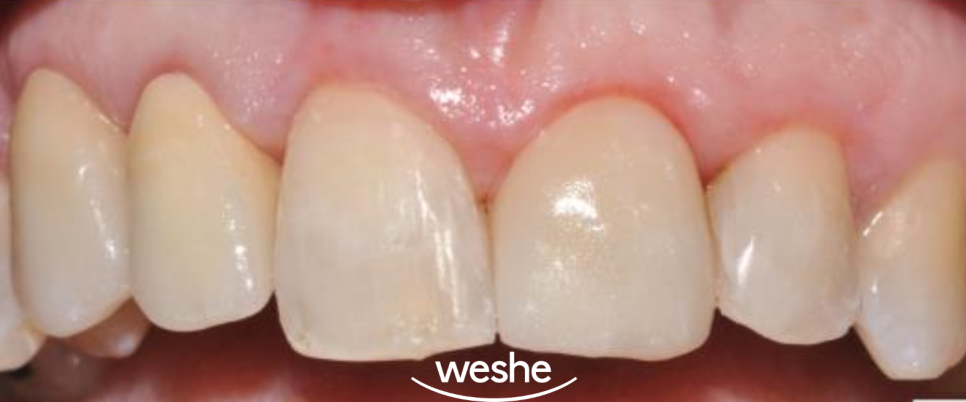 앞니 치아 파절 과 잇몸 염증, 마곡동 치과 의 라미네이트 보철 치료 과정 관련 이미지 2