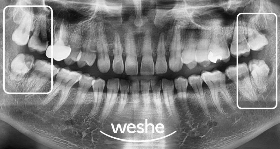 헛구역질(gagging reflex) 때문에 포기했던 구강진료, 해결할 수 있는 방법은? 마곡 수면치과 사랑니발치, 원데이 인레이, 치주치료 관련 이미지 3