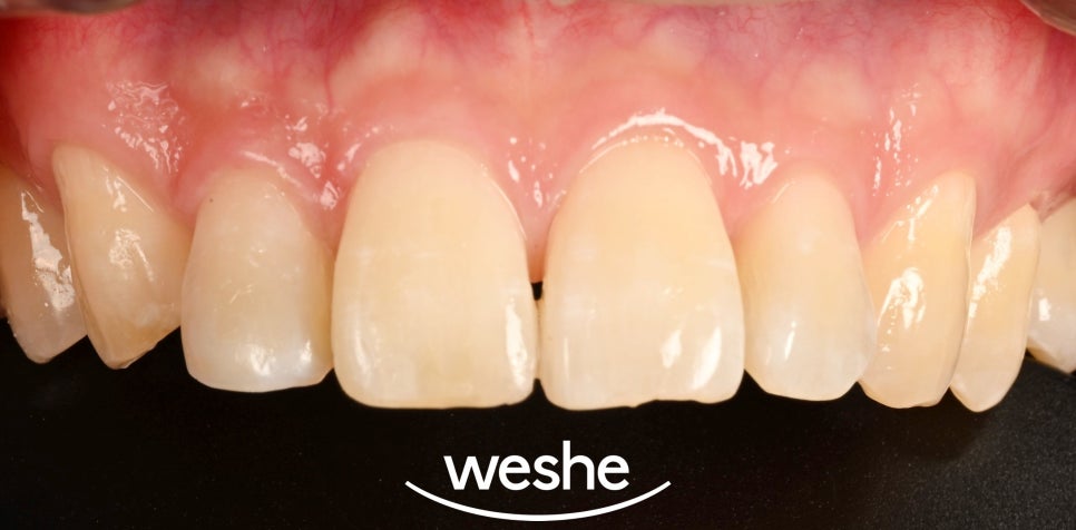 김포공항역 치과 앞니 치아 살짝 깨짐 치료 어떻게 할 수 있을까? 레진 수복 케이스 관련 이미지 3