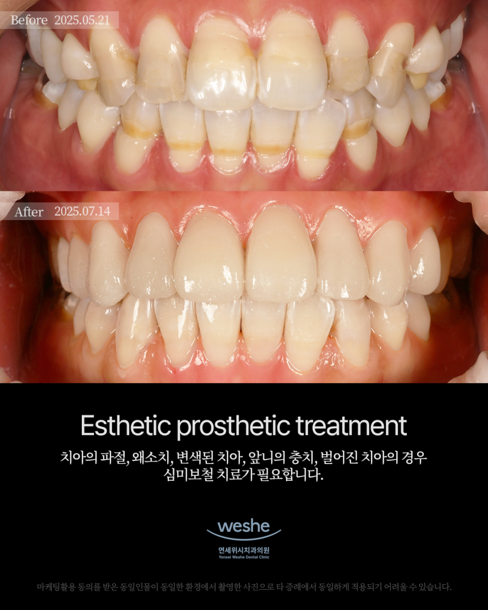 ✨ Esthetic Prosthetic Transformation &ndash; 라미네이트 & 레진 치료 전후 ✨ 관련 이미지 1