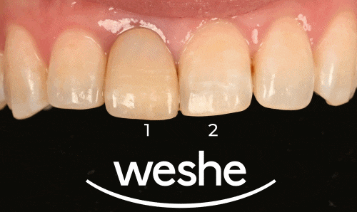 발산 치과 치수 치료 받은 앞니 변색, 왜 크라운이 필요할까? 관련 이미지 2