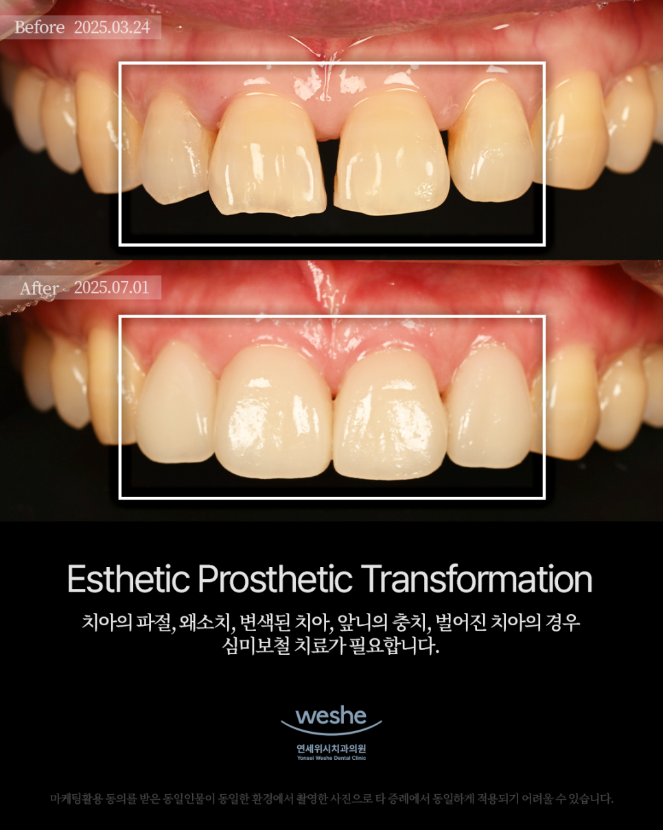 ✨ Esthetic Prosthetic Transformation &ndash; Before and After Laminate Treatment ✨ image 1