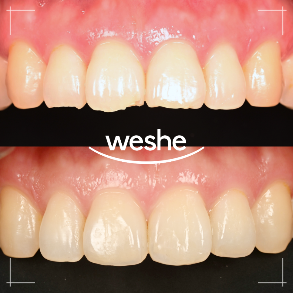 송정역 치과 앞니 치아 끝 살짝 깨짐, 레진 으로 당일 치료 가능한가요? 원인과 진료 방법 관련 이미지 3