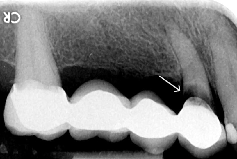 마곡동 치과 정밀 구강 진단을 위한 엑스레이(X-ray) 촬영 필요성과 원리 관련 이미지 3