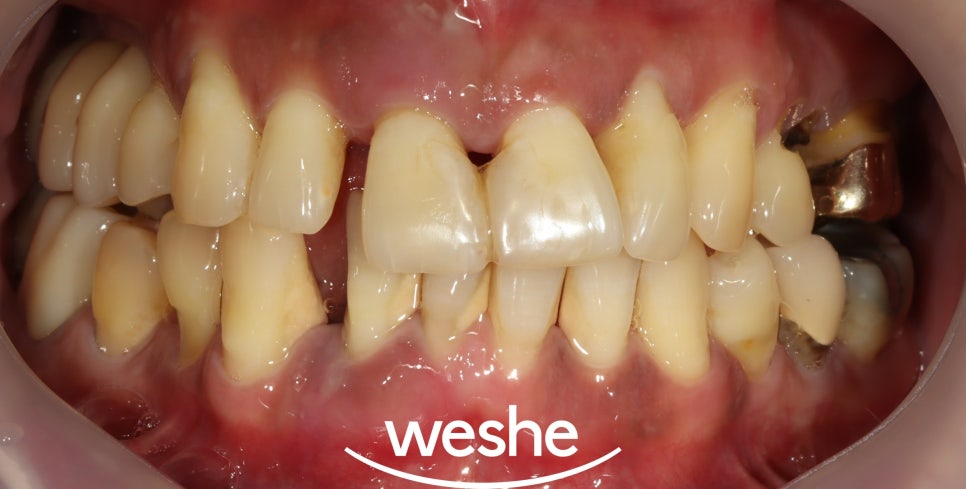 마곡동 치과 치주질환으로 인한 치아 벌어짐, 그리고 임플란트 치료 과정 관련 이미지 3