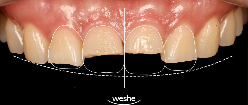 앞니 치아 파절, 마곡 치과 치료 기준과 지르코니아 크라운의 심미적 비율 관련 이미지 4